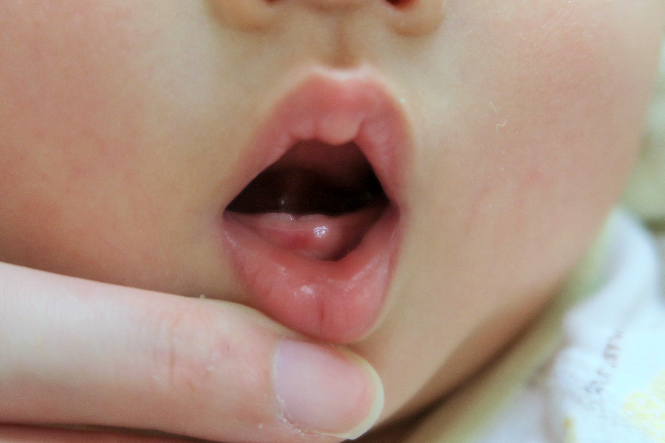 生後８か月の赤ちゃんの口内歯の生え始め